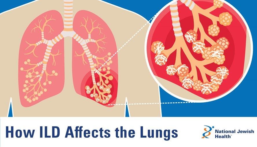 Image of a cross section of lungs showing a magnified section of the alveoli
