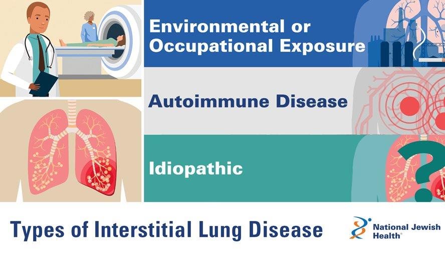 ypes of interstitial lung disease include environmental or occupational exposure, autoimmune disease and idiopathic causes.